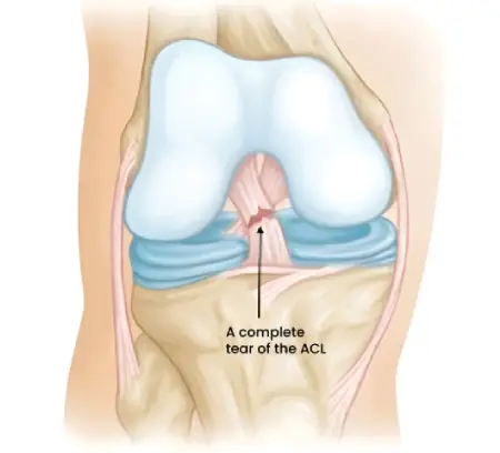 Acl Reconstruction Surgery Surat india