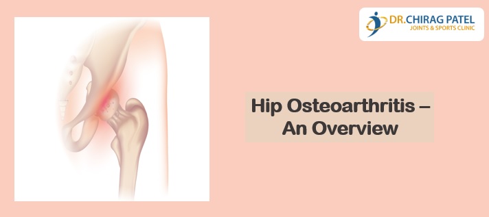 Hip osteoarthritis an Overview