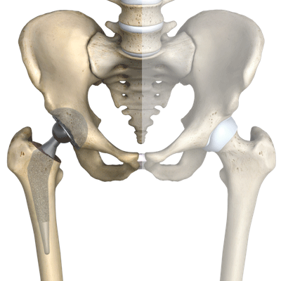 Hip Osteoarthritis treatment Mumbai