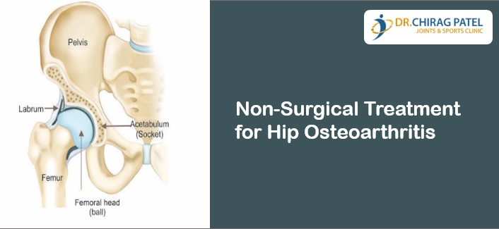 Non Surgical Treatment for Hip Osteoarthritis