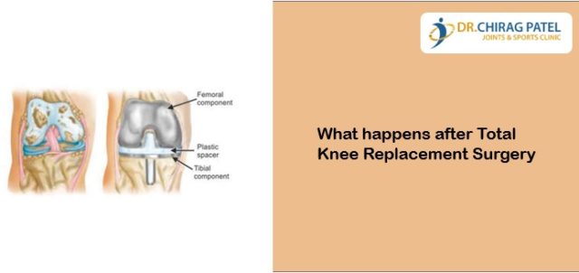 What Happens After Total Knee Replacement Surgery- Dr Chirag
