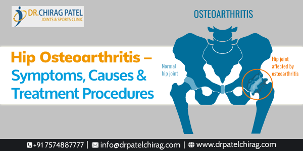 Osteoarthritis knee treatment