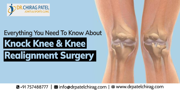 Knock Knee & Knee Realignment Surgery