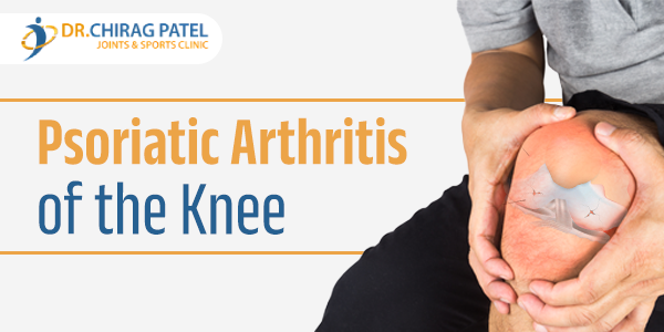 psoriatic arthritis knee pain treatment