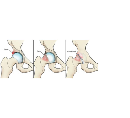 Hip Replacement Surgery in Surat