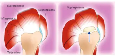 Best Joint Replacement Surgeons in Surat