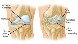 Doctors For Knee Arthroscopy in Surat