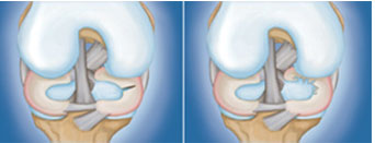 Total Knee Replacement Surgery in india