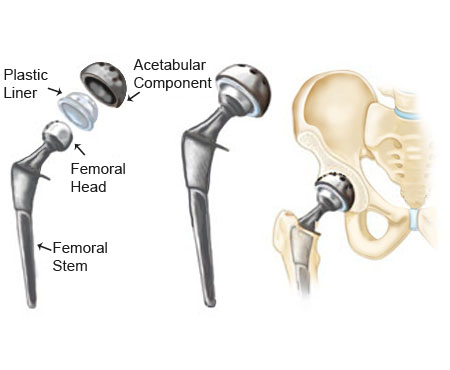 Total Hip Replacement Surgery in india