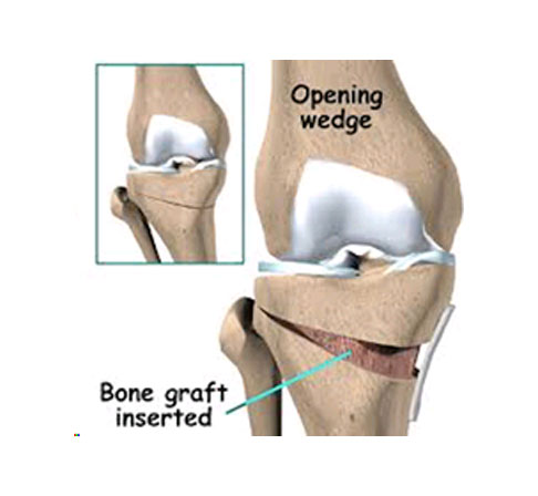 Knee Surgery Doctors in Surat